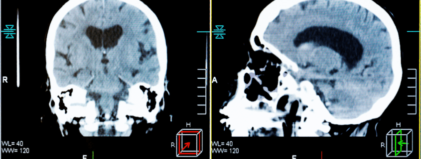 Orland Park Head-On Collision Lawyers